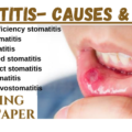 Types of stomatitis, stomatitis meaning, aphthous, herpetic, recurrent aphthous, candidal, ulcerative, viral, & denture stomatitis treatment