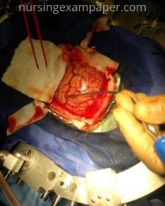 craniotomy surgery picture