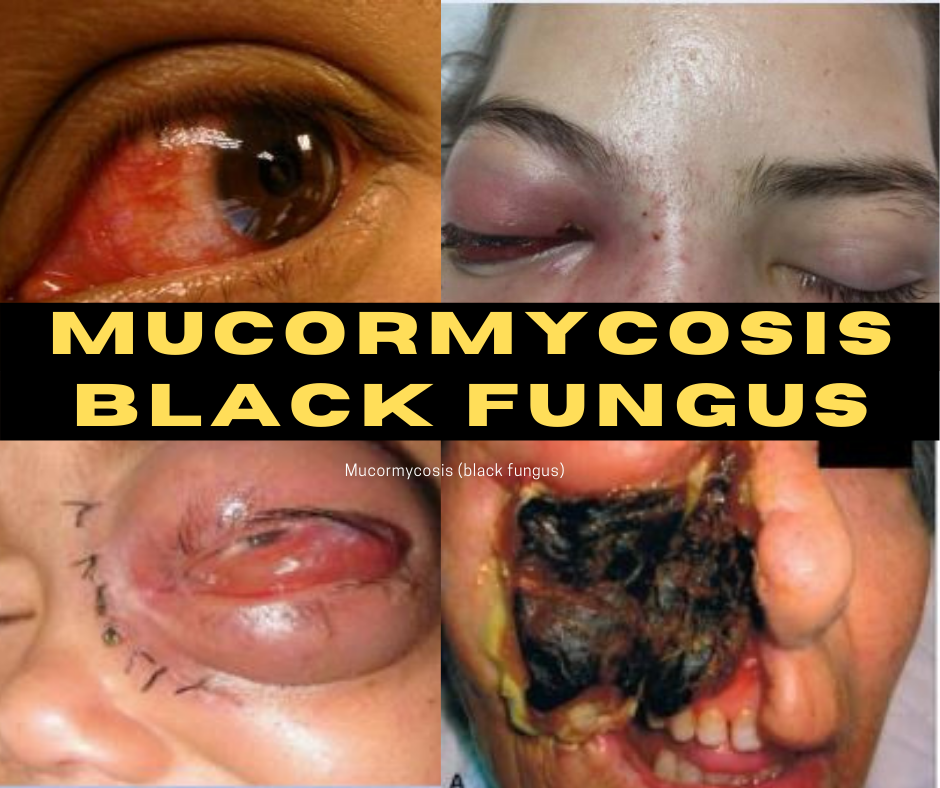 How to spread Mucormycosis (black fungus) infection