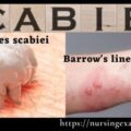 Scabies - Symptoms Treatment of scabies by Permethrin