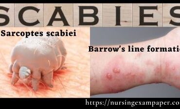 Scabies - Symptoms Treatment of scabies by Permethrin