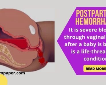 Postpartum Hemorrhage