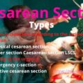 Cesarean Section LSCS