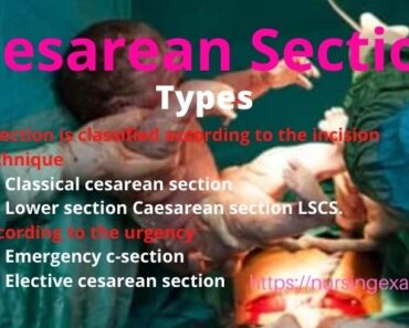 Cesarean Section LSCS