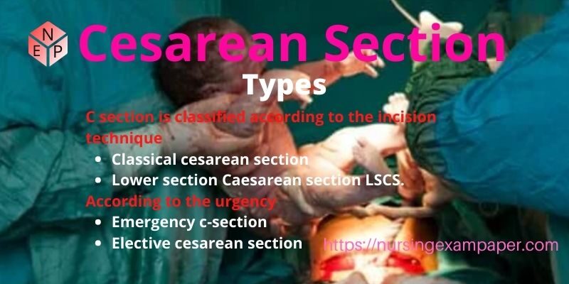 Cesarean Section LSCS