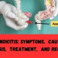 Appеndicitis Symptoms, Causеs, Diagnosis, Trеatmеnt, and Rеcovеry