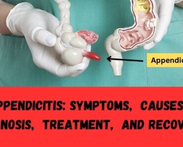 Appеndicitis Symptoms, Causеs, Diagnosis, Trеatmеnt, and Rеcovеry