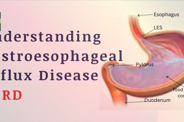 Understanding Gastroesophageal Reflux Disease GERD