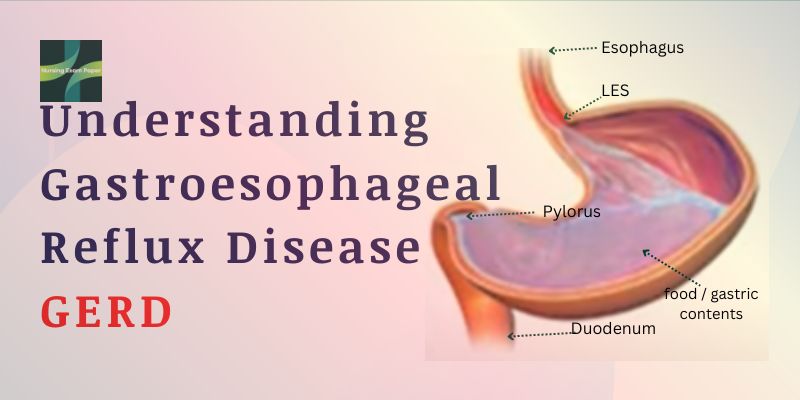 Understanding Gastroesophageal Reflux Disease GERD