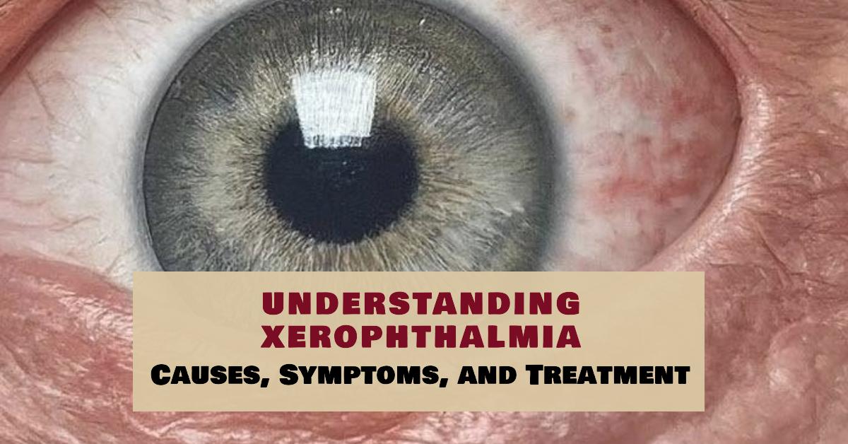 Understanding Xerophthalmia: Causes, Symptoms, and Treatment